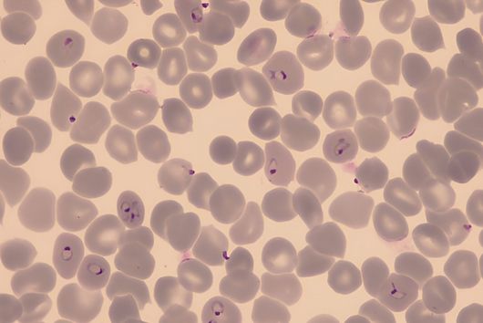 Red blood cells infected with Plasmodium falciparum